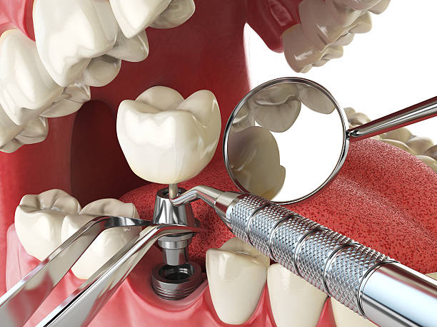Best Emergency Treatment for Dental Infections or Abscesses in New Albany, MS